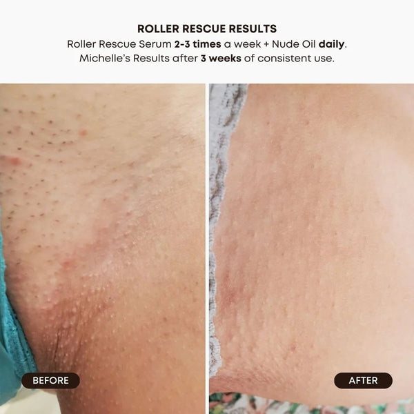 Roller Rescue Ingrown Hair Soothing Serum by Bushbalm
