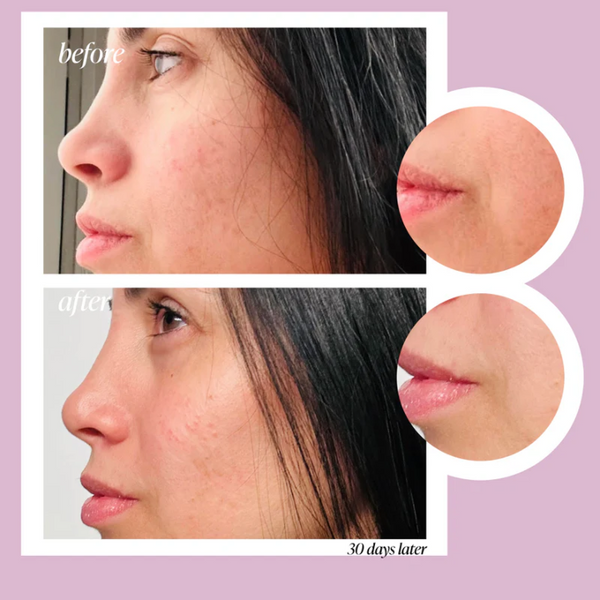 Before and After using Graydon Hydratone Exfoliating Essence