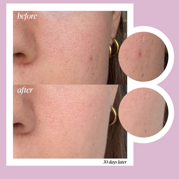 Before and After using Graydon Hydratone Exfoliating Essence