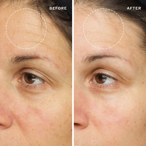 Before and after comparison of a woman's face with visible skin texture reduction.