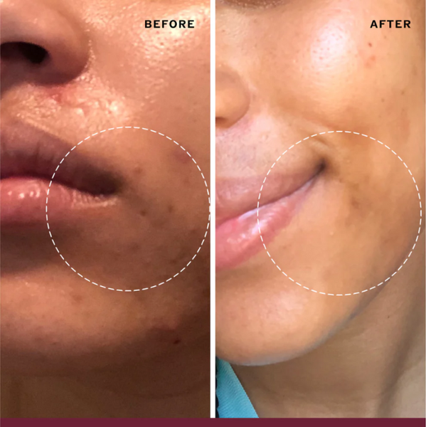 Before and after using Sahajan Golden Milk Cleanser