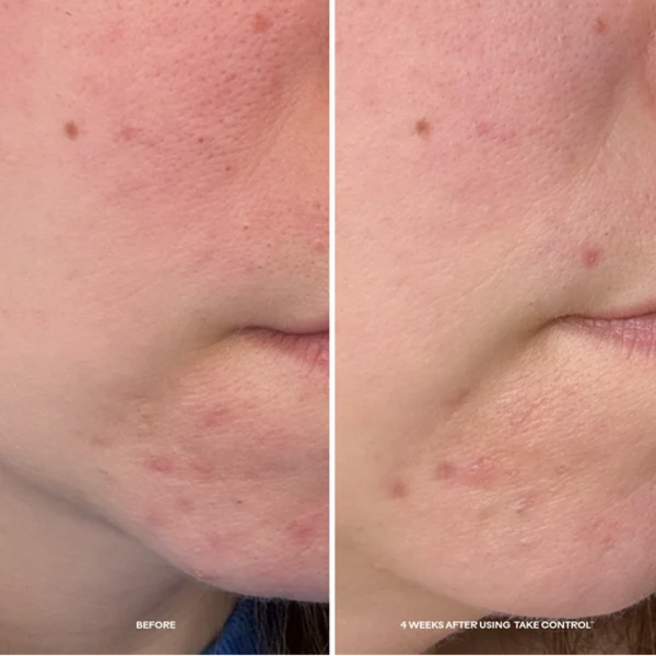 Take Control™ Salicylic + 10% Azelaic Acid Clarifying Serum